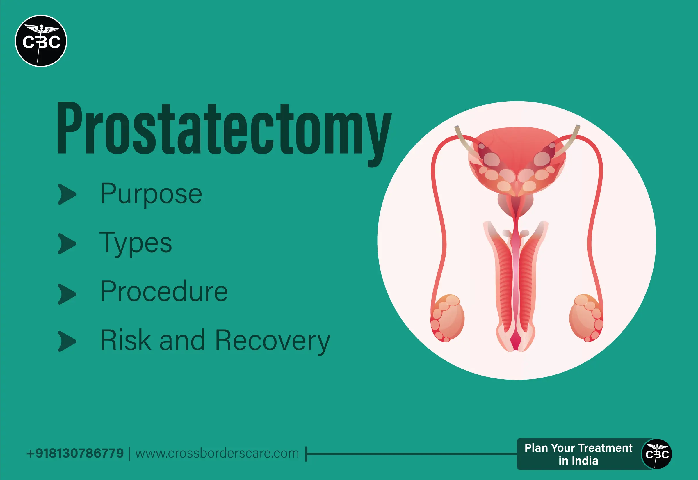 Prostatectomy Purpose Types Procedure Risks And Recovery 8816