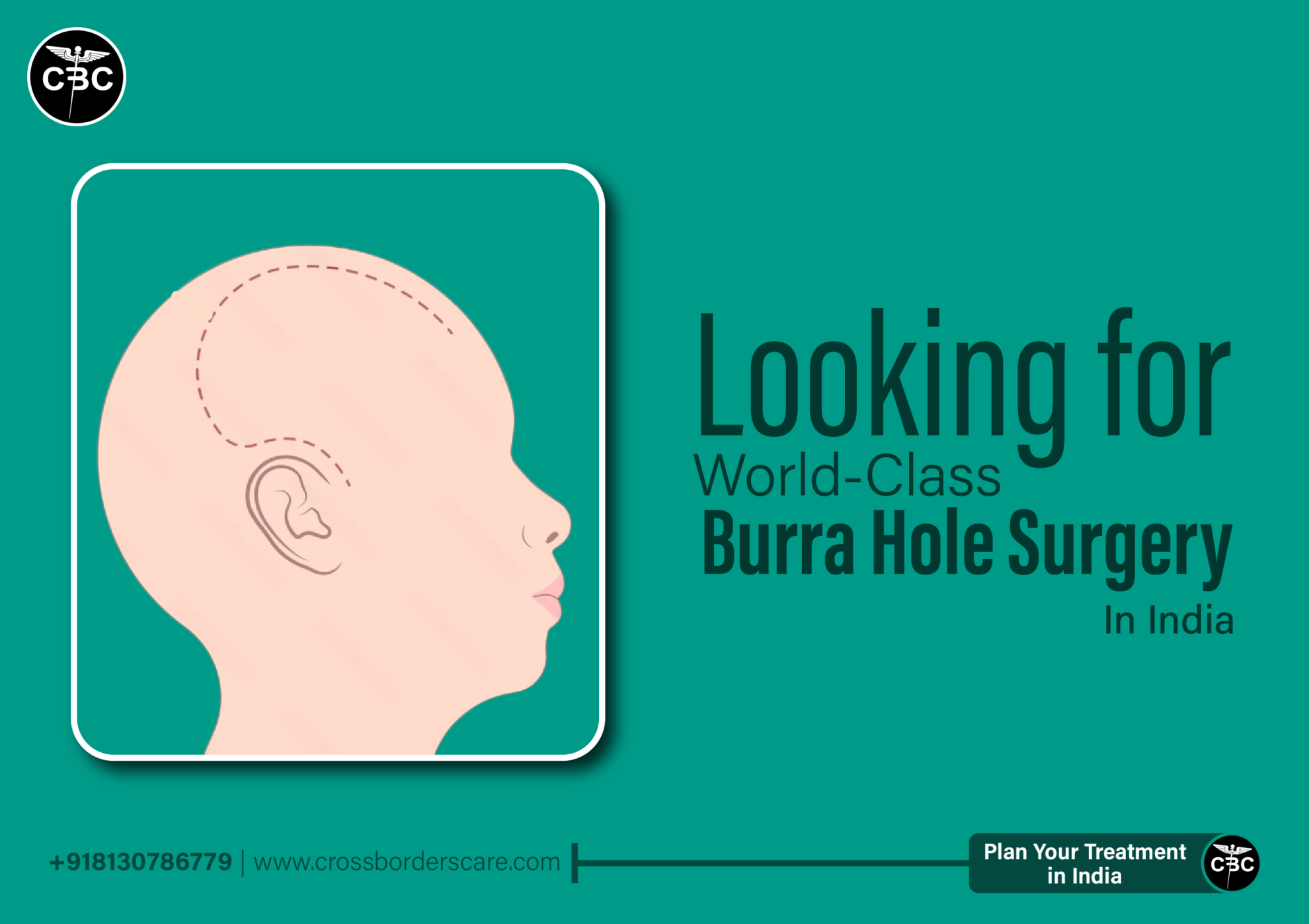 Burr Hole Surgery Cost in Delhi, India | Crossborders Care