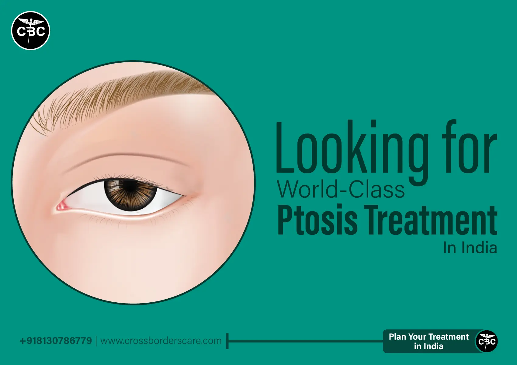 PTOSIS TREATMENT